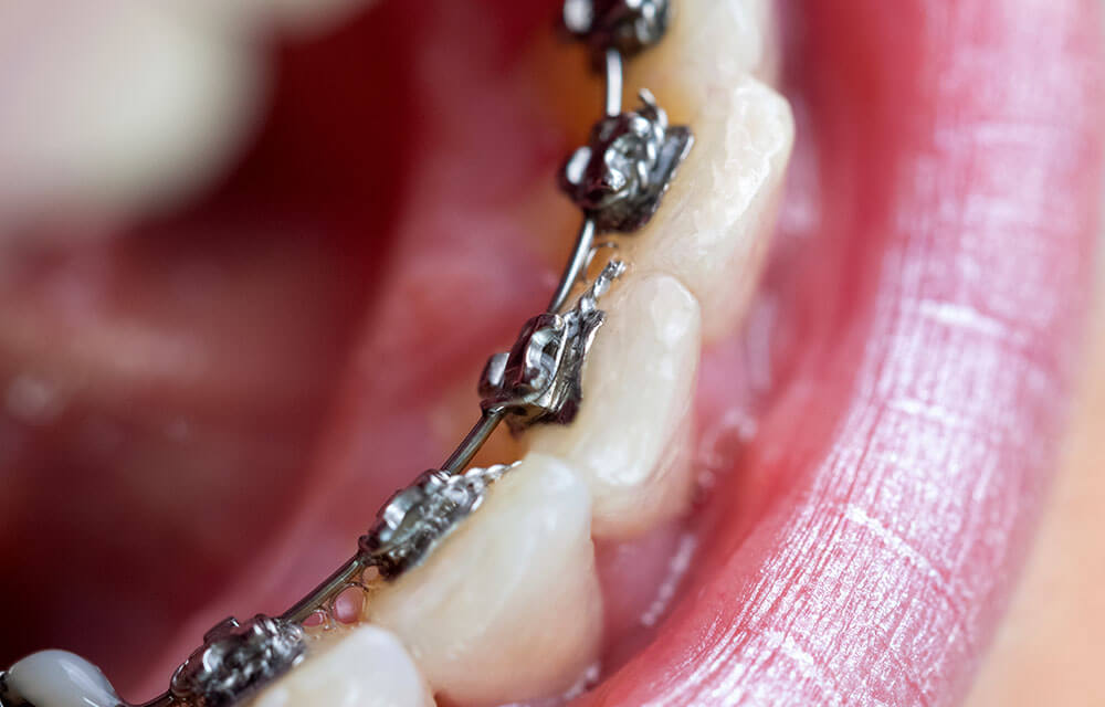 What Are Lingual Braces? 