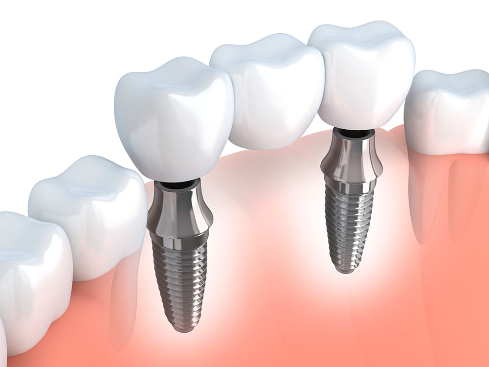 What Is A Dental Bridge?