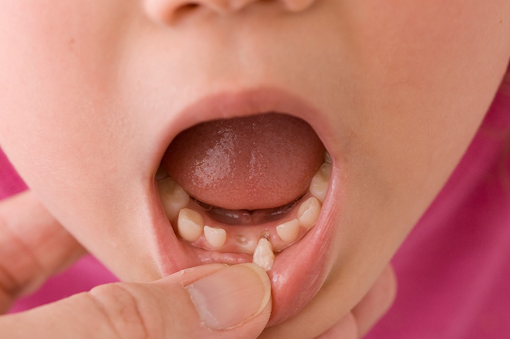 Looking inside a child's mouth with a loose tooth.
