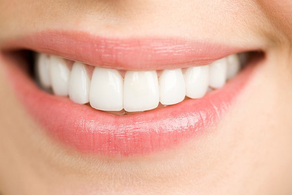 What Are Porcelain Dental Veneers?