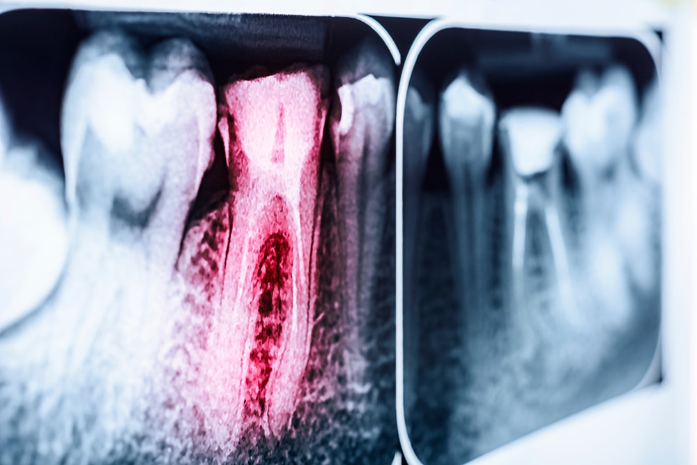 root-canal-treatment xray