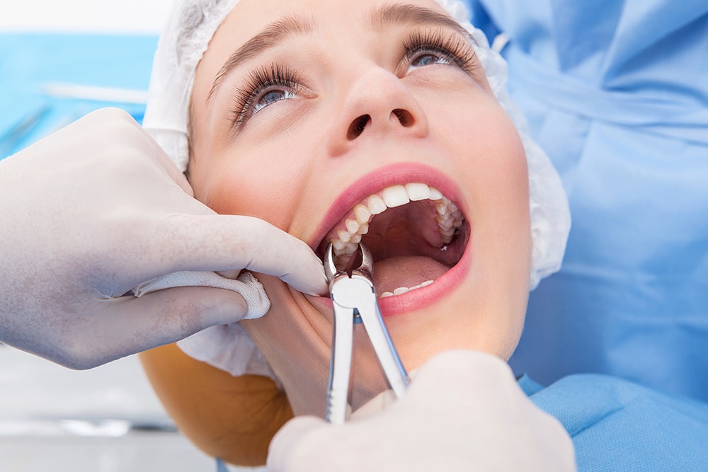 tooth extraction